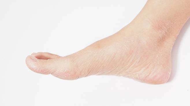 발 각질을 제거할 때는 발을 완전히 건조한 뒤 발 전용 각질제거기인 '버퍼(Buffer)'를 이용해 피가 나지 않을 정도로만 살살 긁어내는 걸 권장한다./사진=게티이미지뱅크