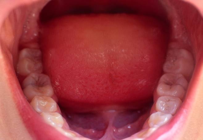 올바른 혀 위치는 혀의 끝, 중간, 뒷부분을 모두 입천장에 대는 것이다./사진=클립아트코리아