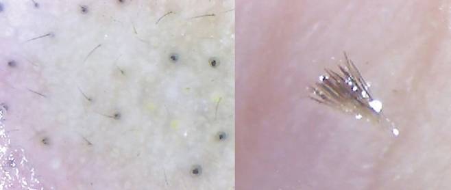 사진=Indian Dermatology Online Journal 논문 중 'Trichostasis spinulosa'