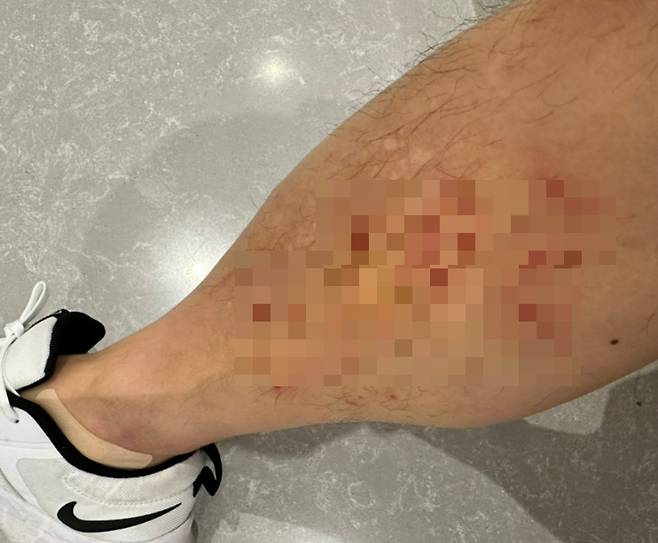 40대 직장인 A씨가 태국에서 마사지를 받고 난 뒤에 오른쪽 다리에 붉은 반점이 생겼다. /사진=독자제공