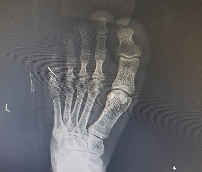 철심 박은 B 병장 발 [A씨 제공. 재판매 및 DB 금지]