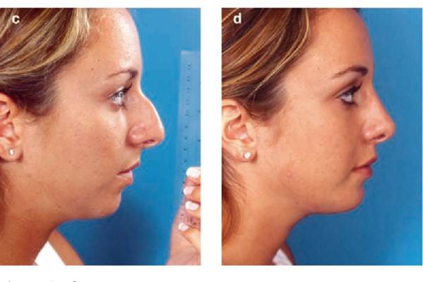 서양인의 매부리코 수술은 대부분 '큰 코를 줄이는 것' [사진=Mastering Rhinoplasty - Rollin K. Daniel]