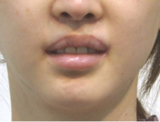 과도하게 짧은 인중은 어색합니다.