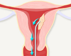 자궁내막에 생기는 악성종양인 자궁내막암은 조직검사를 통해 진단하는 경우가 대부분이다. 보건복지부 제공