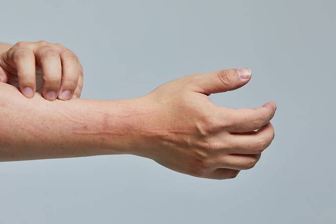 모기에 물린 후 유독 붓고 가렵다면 '스키터증후군'을 의심해야 한다./사진=게티이미지뱅크