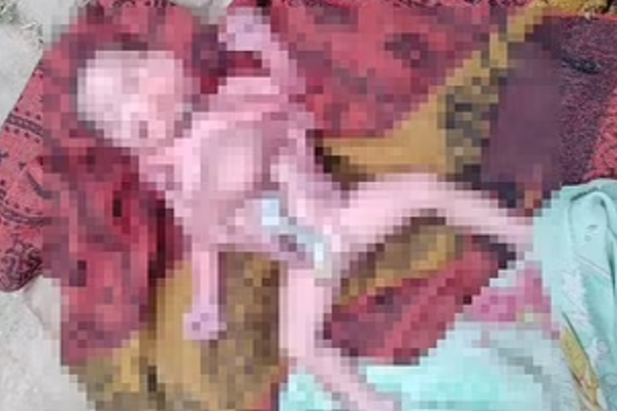 얼굴 2개, 팔 4개, 다리 4개를 가지고 태어난 아기 모습. 데일리메일 캡처