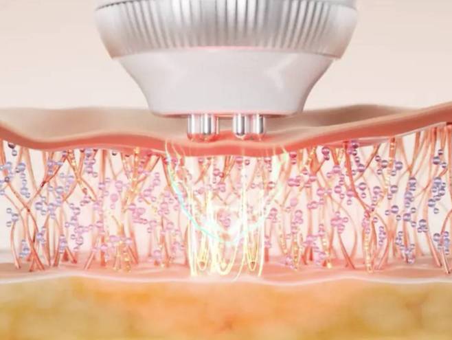 전극이 피부에 고주파와 미세 전류를 전달해 콜라겐 생성을 촉진한다. 사진은 이해를 돕기 위해 연출한 이미지 / 출처=메디큐브