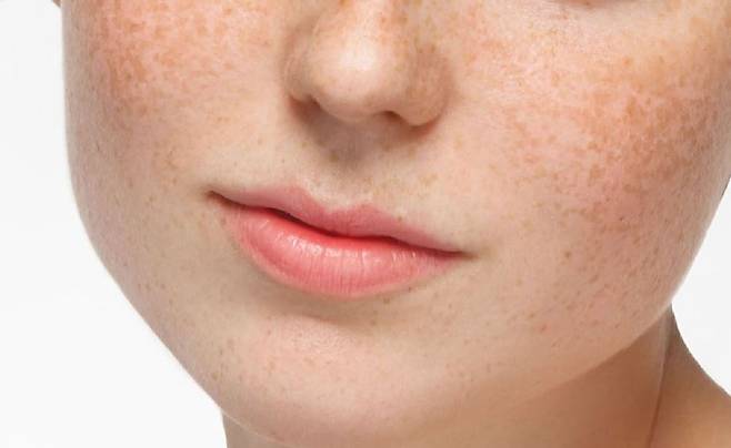 기미와 주근깨를 예방하기 위해선 근본적으로 자외선을 차단하는 것이 중요하다./사진=게티이미지뱅크