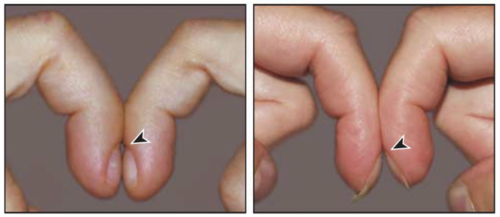 다이아몬드·화살촉 모양의 샴로트 창문이 생긴 정상 손가락(왼쪽)과 샴로트 창문 공간이 사라지고 빈틈없이 붙은 곤봉지(오른쪽). [사진 출처=Pallares-Sanmartin 2010]