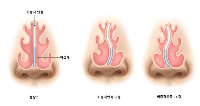 비중격만곡증은 콧구멍을 둘로 나누는 벽인 '비중격'이 휘어진 것으로, 코막힘이나 부비동염 등 기능적 장애를 유발할 수 있다./사진=클립아트코리아