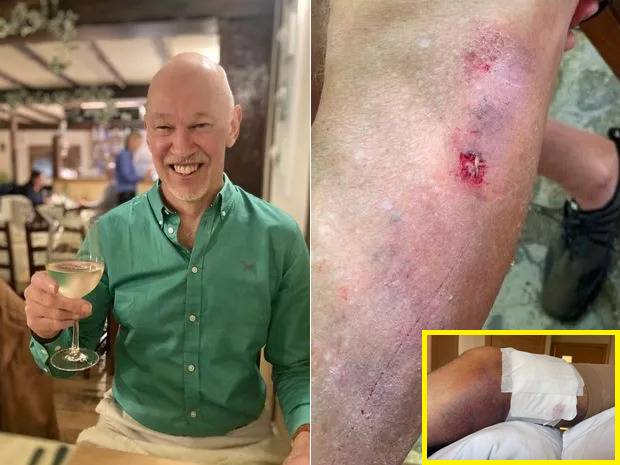 바다에서 수영 후 세균에 감염돼 다리를 두 번이나 잘라냈으나 결국 사망한 남성 사연이 공개됐다. 그가 감염된 균은 '살 파먹는 박테리아'라고 불리는 비브리오 불니피쿠스로 치사율이 50% 정도로 높다. [사진=영국 매체 미러 보도 갈무리/PA]