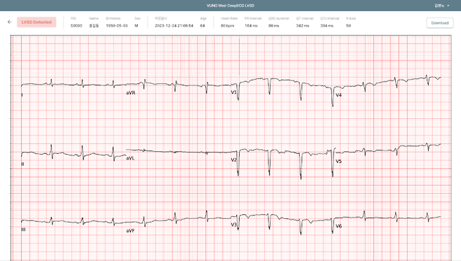 뷰노의 심부전 선별 의료기기 '뷰노메드 딥ECG LVSD' 운영화면 예시 [사진=뷰노]