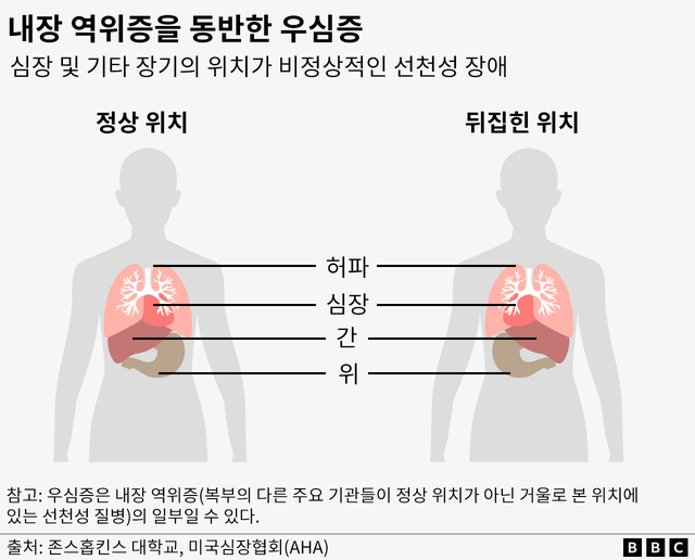 정상적인 장기 구조와 우심증 및 내장 역위증 환자의 장기 구조