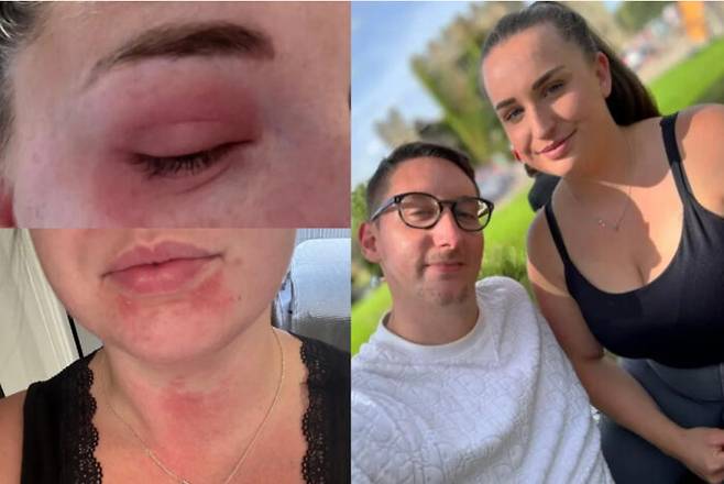 피임 장치 코일 시술을 받은 후 생리 기간이 돌아올 때마다 알레르기 증상으로 고생한 여성의 사연이 소개됐다. [사진='더선' 보도내용 캡처]