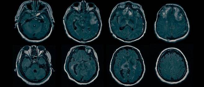 기능적 자기공명영상(fMRI)은 뇌의 특정 부위가 활성화할 때 발생하는 혈류 변화를 탐지하는 방식으로 뇌 활동을 영상화하는 기술이다. 컬럼비아대 제공