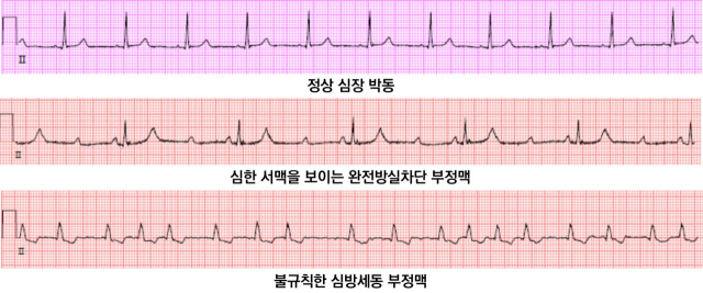 정상 심장 박동(위쪽부터)과 심한 서맥을 보이는 완전방실차단 부정맥, 불규칙한 심방세동의 심전도 그래프. 사진 제공=서울아산병원