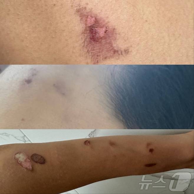 일명 '골보파'라는 조직폭력배들에게 A 씨가 폭행당해 몸 전신에 상처를 입었다 2024.8.27/뉴스1 신성훈 기자