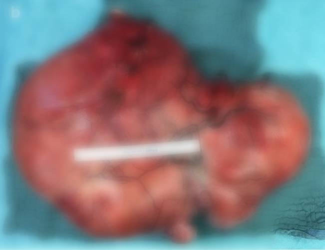 독일 46세 여성의 뱃속에서 나온 16.4kg에 달하는 거대 자궁근종./사진=의학사례보고저널