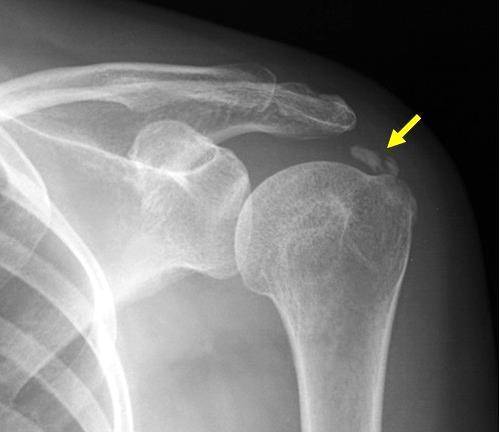 * 사진 설명; 46세 여성 좌측 어깨에 발생한 석회성 건염