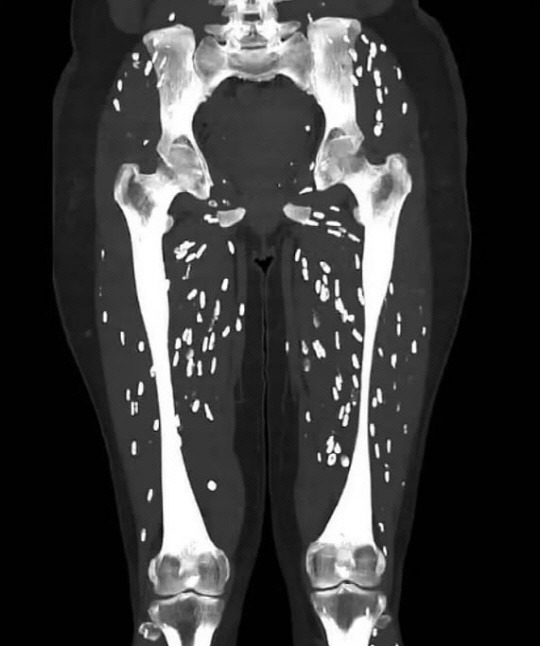 '낭미충증' 기생충에 감염된 환자의 다리 CT 사진.   [X(옛 트위터]