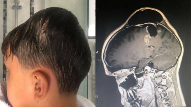 영국의 한 10대 소년이 뇌종양을 진단받은 사연이 공개됐다./사진=더 선