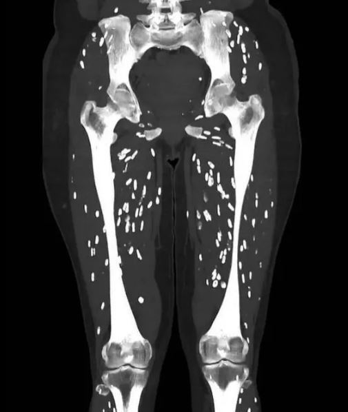 최근 낭미충증이라는 기생충에 감염됐다는 외국 환자의 컴퓨터 단층 촬영(CT) 사진. 샘 갈리 미국 플로리다대학 응급학 의사 엑스(X·옛 트위터) 계정 캡처