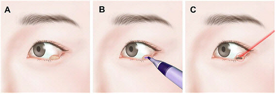 신현진 교수가 개발한 레이저를 이용한 눈꺼풀 종양 제거술은 눈꺼풀 종양(A)를 보라색 마킹펜으로 염색(B) 후, 레이저를 조사해 종양을 제거하는 방법으로 3분 정도의 짧은 시술시간과 칼로 절개 없이 진행해 통증은 최소화 하면서 안전하고 빠르게 종양을 제거할 수 있다.