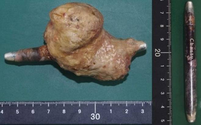 한 60대 일본 남성은 3년 전 항문에 넣은 아이라이너가 방광 결석을 유발하고 콩팥 감염을 일으켜 사망했다. 사진은 이 남성의 몸에서 나온 방광 결석과 그 안에 꽂혀 있던 아이라이너./사진='Forensic Science International: Reports' 캡처