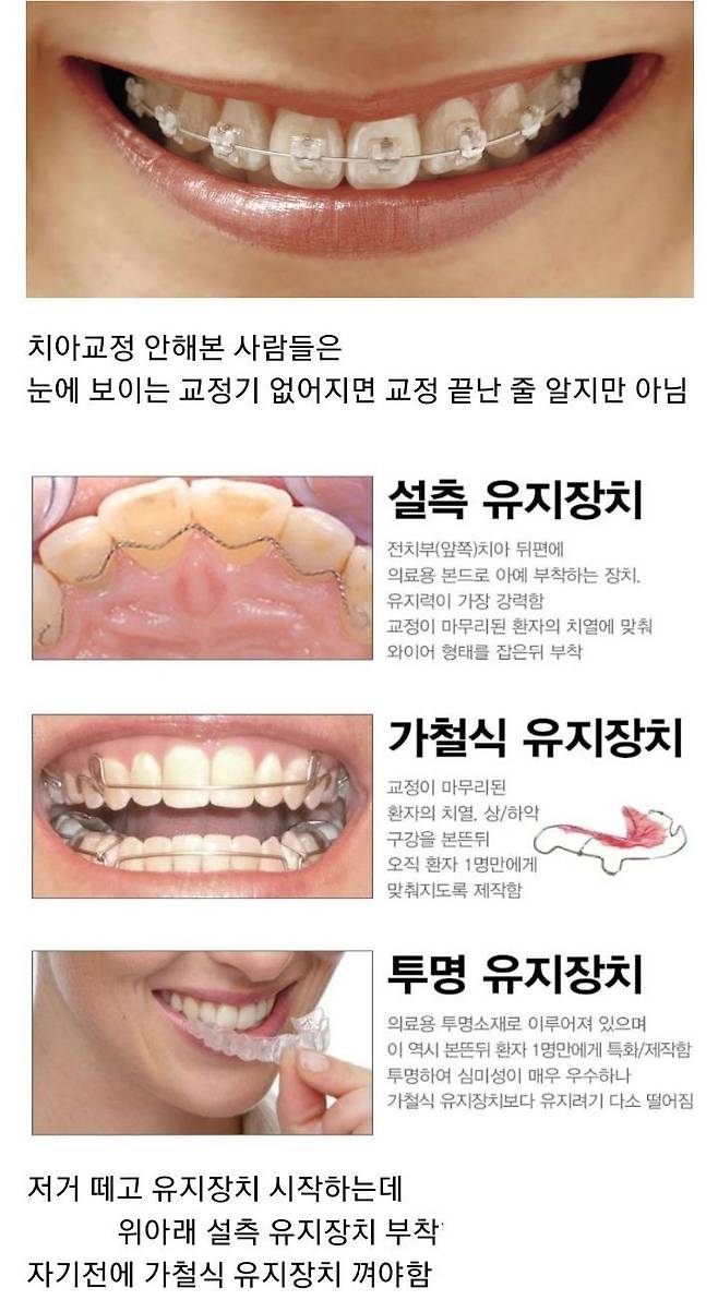 치아교정이 힘든이유