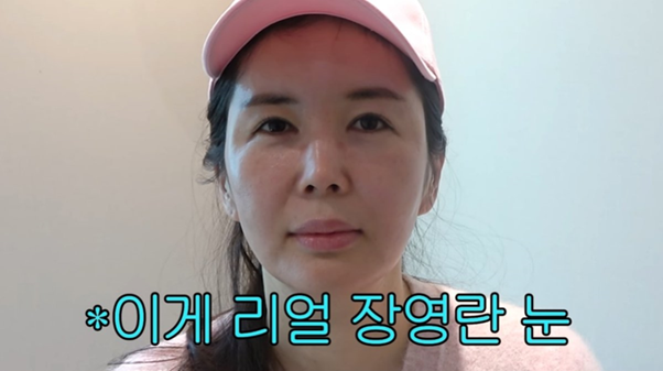 수술 전 장영란 씨의 눈 상태. 두 가지 수술이 모두 도움 되는 눈입니다. [사진=유튜브 채널 'A급 장영란']