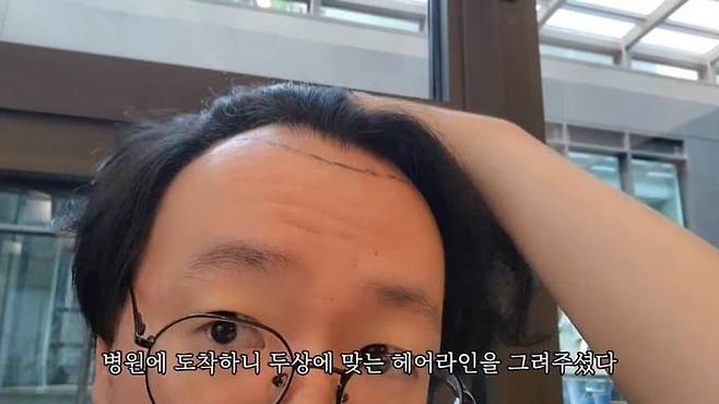 터키에 모발이식 수술 하러 간 탈모인