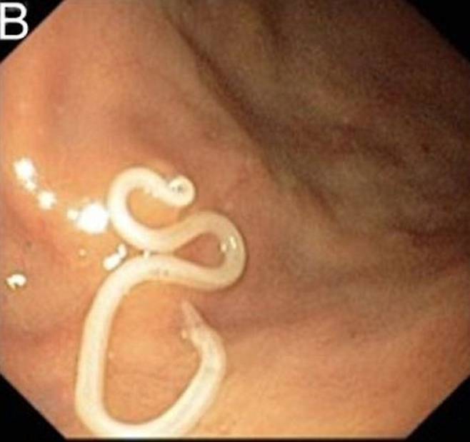 30대 남성이 초밥을 먹은 후 기생충 감염으로 심한 통증 증상을 겪었다. 이 사진은 이 남성의 위에서 발견된 기생충의 모습이다./사진=BMJ 사례 보고서