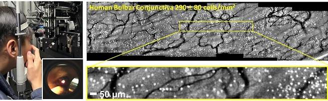결막 술잔세포 영상화 검사 장면(왼쪽)과 획득한 대면적 술잔세포 영상. 포스텍 제공.