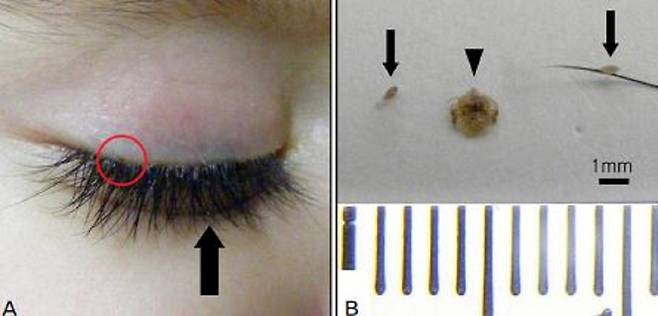 12개월 된 인도 남자아이의 속눈썹에 사면발이가 발견된 사례가 공개됐다. 이 사진은 실제 이 남자아이의 속눈썹에서 발견된 사면발이 사진이다./사진=대한안과학회지