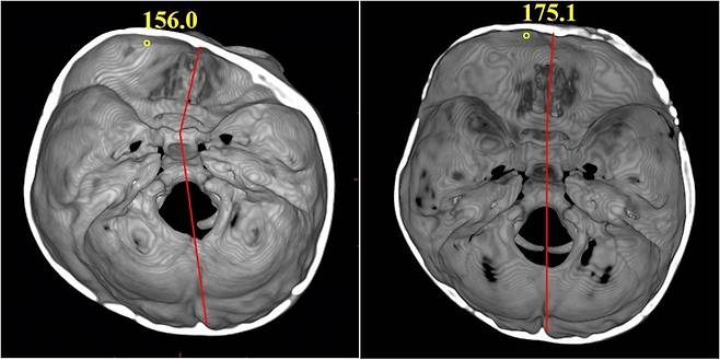 신연기를 이용한 두개골 성형술 전후 두개골 조기 유합증 환아의 뇌 CT 검사 사진. 수술 전(왼쪽)에 비해 수술 후(오른쪽) 두개골의 모양 및 뇌 기저부의 대칭성이 회복된 것을 확인할 수 있다.  서울아산병원 제공