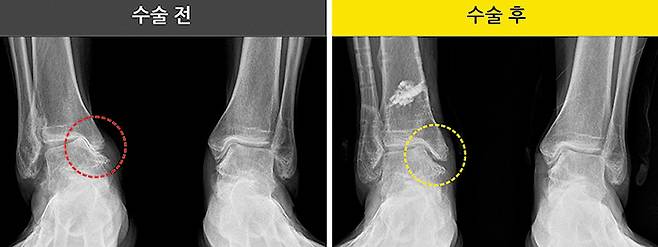 체중 부하 축을 정상연골이 있는 쪽으로 옮기고 자가골수 줄기세포를 심어 발목관절염을 치료한다./연세건우병원 제공