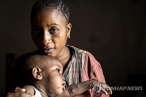 콩고민주공화국의 어린이 엠폭스 환자 [EPA 연합뉴스 자료사진. 재판매 및 DB 금지]