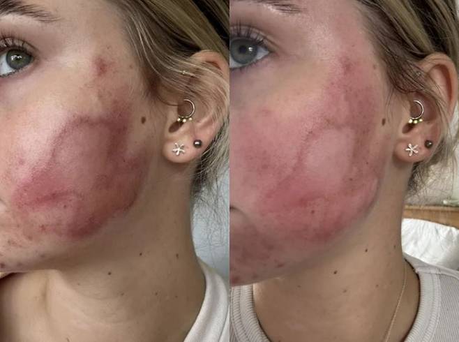 영국의 한 20대 여성이 여드름 흉터 치료 중 부작용을 겪은 사연이 공개됐다./사진=더 선