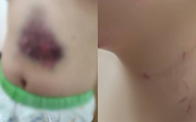 지난해 10월14일 새벽 대전 중구의 한 모텔에서 또래에게 폭행당해 배와 얼굴 곳곳에 멍과 상처를 입은 피해 여고생의 모습. SBS 보도화면 갈무리