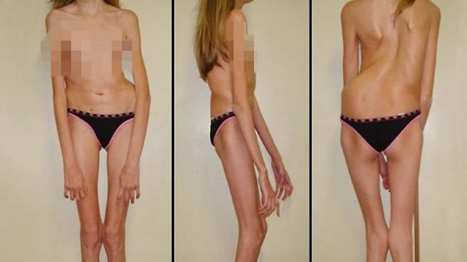 마르판 증후군은 골격계 이상을 일으킬 수 있다./사진=Healthline