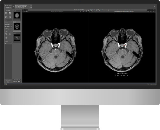 딥노이드의 뇌동맥류 진단보조 AI 솔루션 '딥뉴로' 판독 화면. 딥노이드 제공.