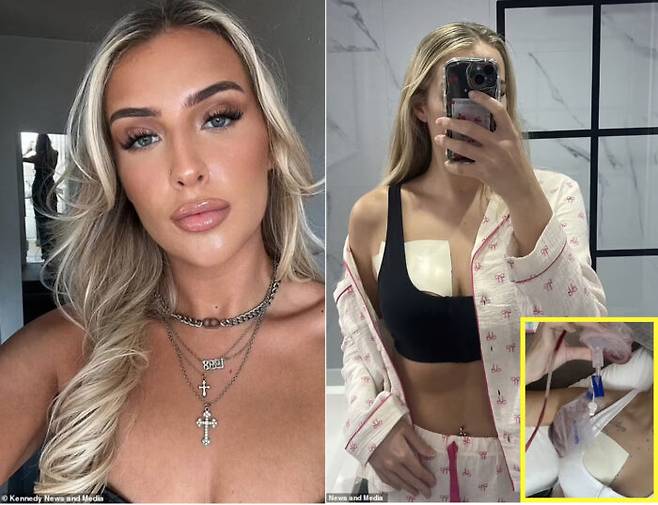 26세에 초기 유방암에 걸려 왼쪽 가슴을 절제한 여성 사연이 공개됐다. 지난 6월 왼쪽 가슴에서 출혈, 멍울 등 증상이 나타난 후 여러 번 병원을 찾은 이 여성은 유관 상피내암이라는 진단을 받았다. [사진=영국 매체 데일리메일 보도 갈무리 / Kennedy News and Media]