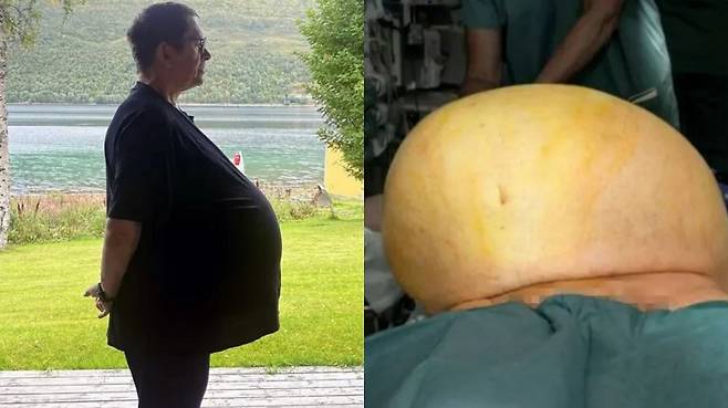 노르웨이의 한 50대 남성의 배에서 거대 종양이 발견된 사연이 공개됐다./사진=뉴욕포스트