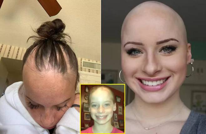 8살부터 탈모 증상을 겪은 20대 여성 사연이 공개됐다. 초기에는 작은 원형 모양으로 머리카락이 빠져 가리고 다닐 수 있을 정도였지만 시간이 지날수록 증상은 더욱 악화했다. 결국 여성은 고등학생 때 남아있는 머리카락이 거의 없어 삭발을 결심했다. [사진=미국 매체 피플 보도 갈무리]