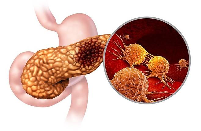 췌장암 모식도./서울대병원