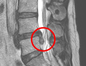 허리디스크 환자 MRI 사진. 4번 5번 뼈 사이에 디스크가 튀어나와 신경을 누르는 상태.