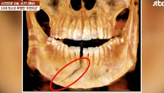 주한미군에 맞아 턱뼈가 골절된 10대 남학생의 엑스레이 사진.[사진 제공 = JTBC 사건반장 캡처]