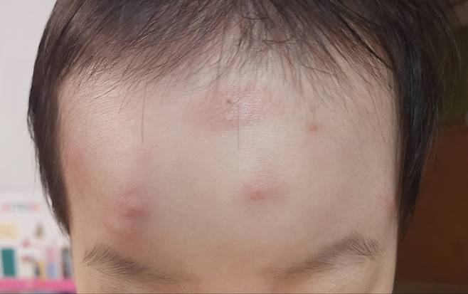 11월 말에도 모기에 물린 아이의 모습. [독자 제공]