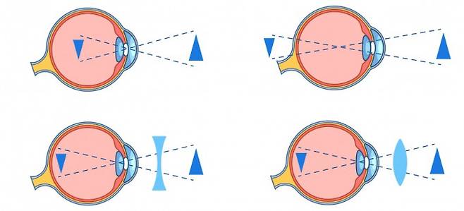 (왼쪽부터) 근시는 초점이 망막 앞에 맞아 오목렌즈를 써서 빛을 좀 더 퍼지게 하고 원시는 초점이 망막 뒤에 맞아 볼록렌즈를 써서 빛을 좀 더 모이게 한다. 게티이미지뱅크 제공