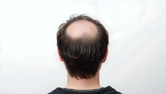 Some people worry that exercising hard will increase male hormones and cause hair loss. However, exercise neither causes nor worsens hair loss. [사진=픽사베이 @izhar-ahamed]